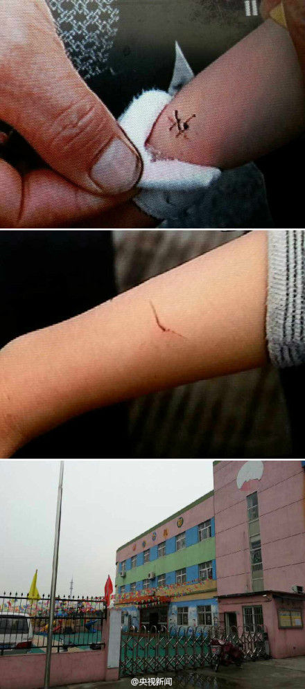 上海一幼儿园老师用剪刀剪伤7名孩子手腕